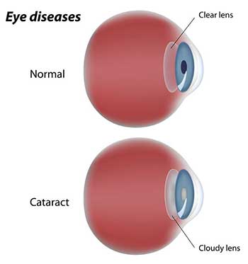 Cataracts Surgery in West Orange